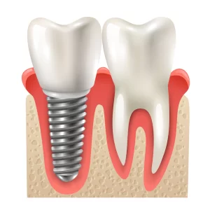 implantes dentales