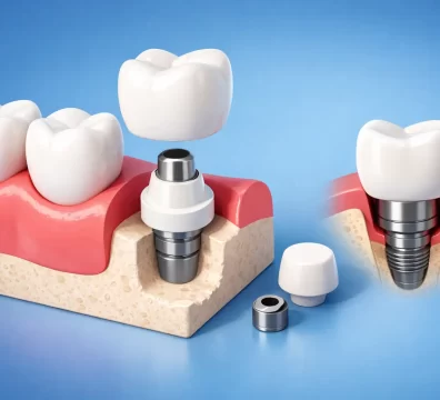 Implantes dentales sin tornillos: ¿existen?